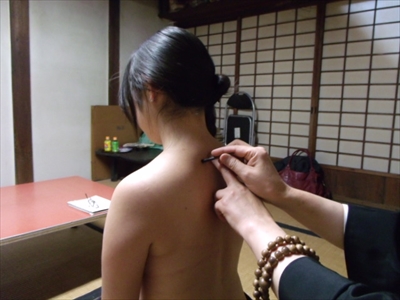 灸を据える